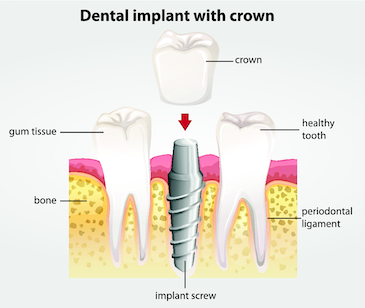 dental implant with crown illustration