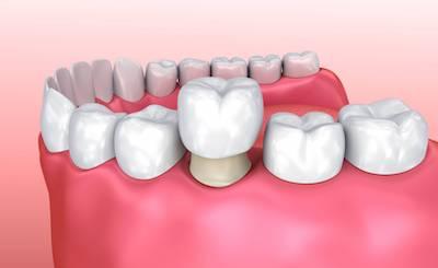 Dental Crowns Wilmette IL