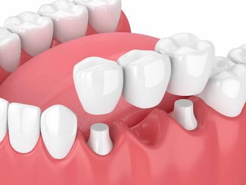 Dental Bridge Wilmette IL