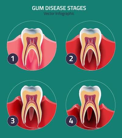 Periodontal Disease Treatment in Wilmette, IL
