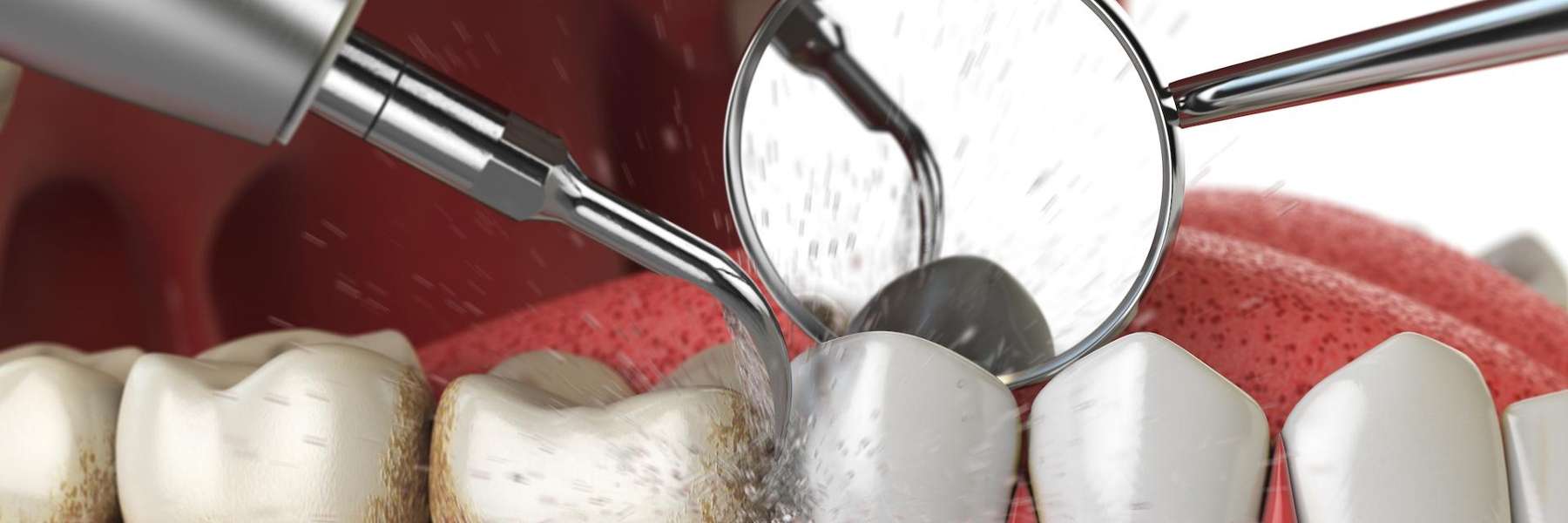 dental cleaning | Wilmette Dental Institute
