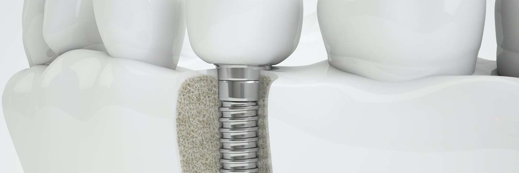 dental implant post wilmette il