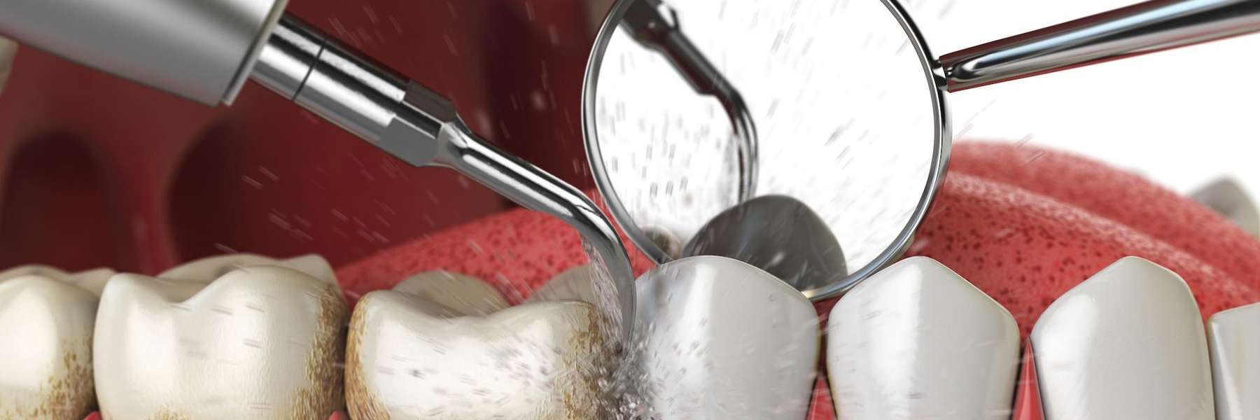 Dental Cleaning in Wilmette IL