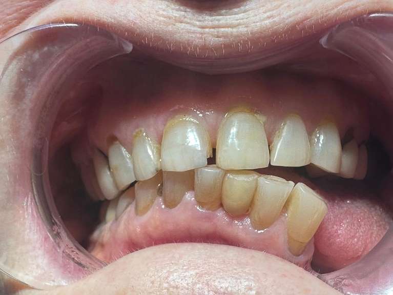 Tooth-Replacement-After-Image