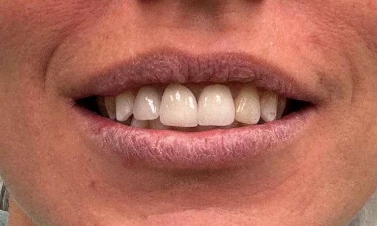 Dental-Implants-After-Image