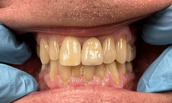 After Dental Implant