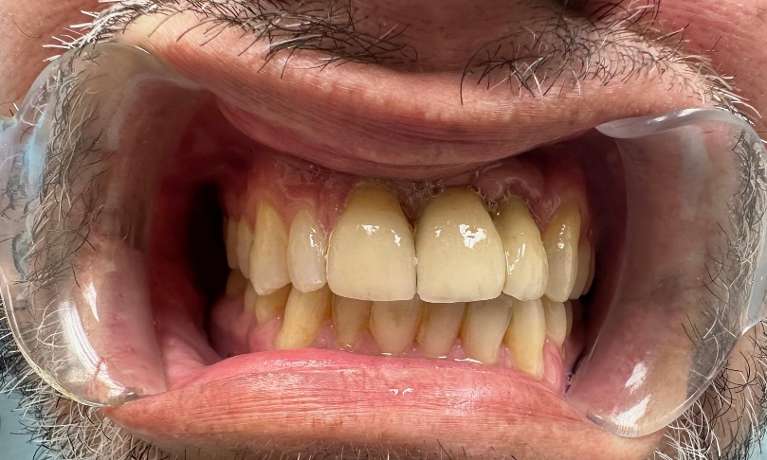 Dental-Implants-Crown-After-Image
