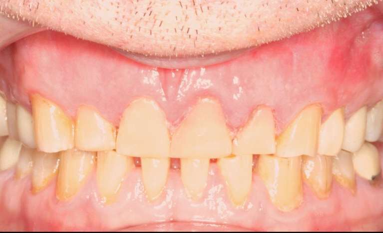 Middle-Aged-Man-Who-Had-Severe-Wear-on-His-Teeth-We-Fixed-His-Smile-with-Composite-Veneers-After-Image