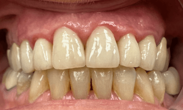 Smile-Makeover-After-Image
