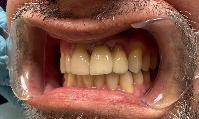 After Dental Implants & Crown