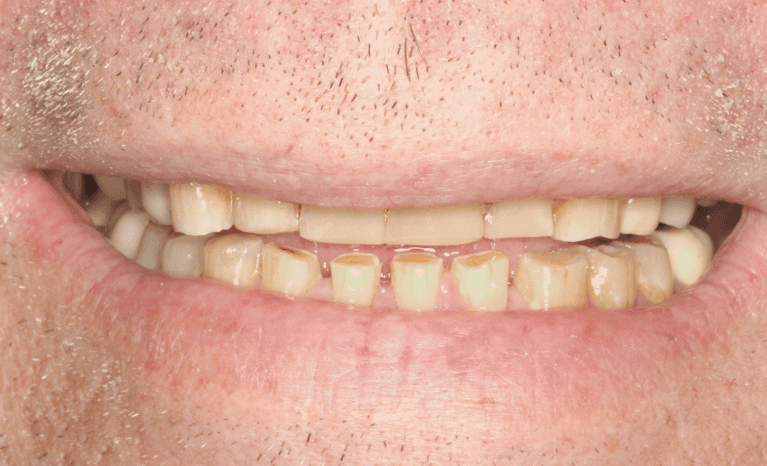 after composite veneers
