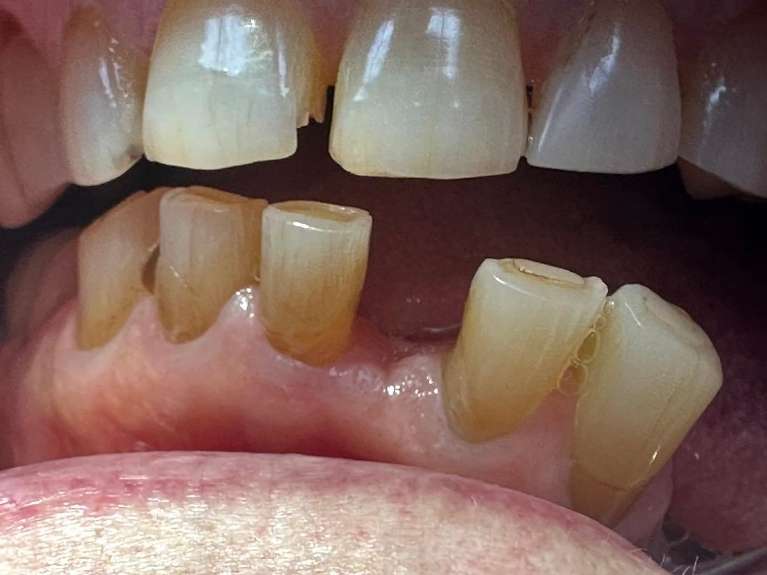 Tooth-Replacement-Before-Image