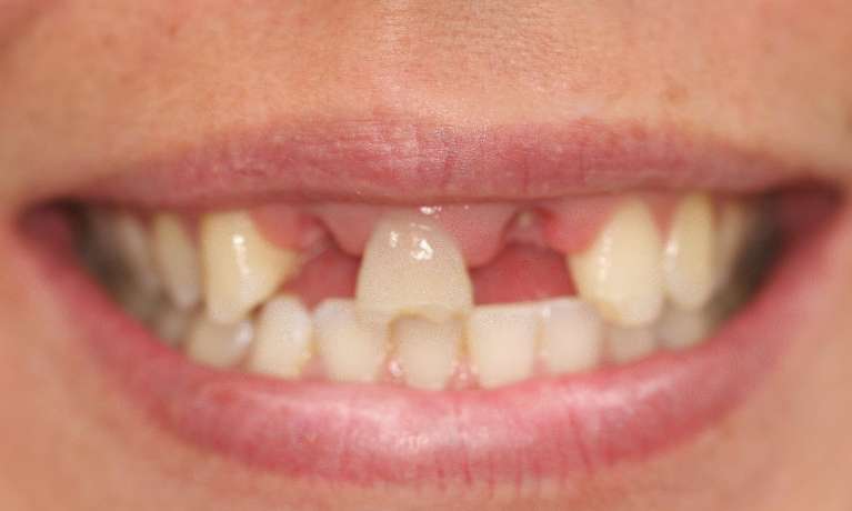 Dental-Implants-Before-Image