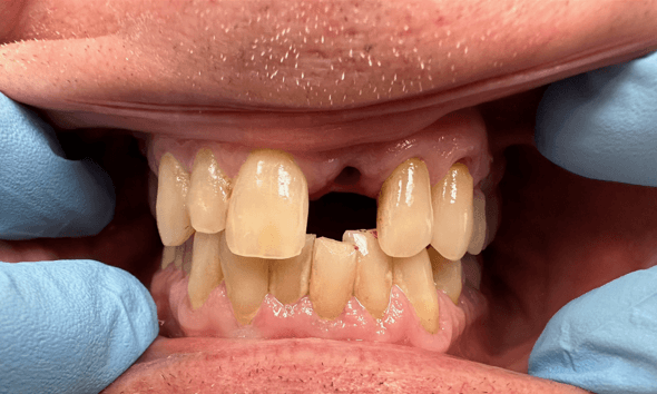 Before Dental Implant