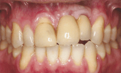 Dental-Implants-Crown-Before-Image