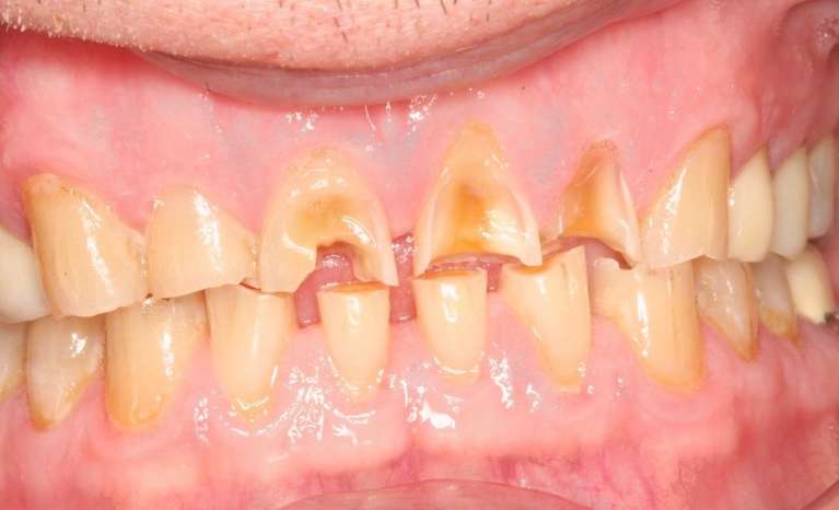 Middle-Aged-Man-Who-Had-Severe-Wear-on-His-Teeth-We-Fixed-His-Smile-with-Composite-Veneers-Before-Image