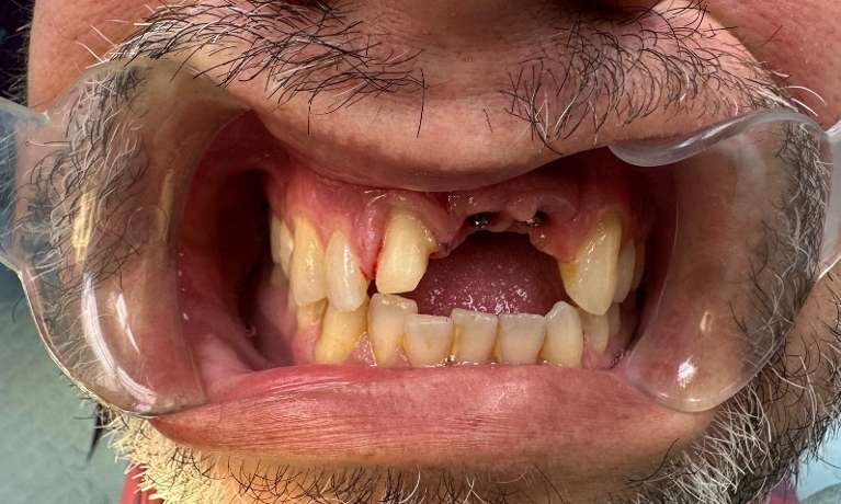 Before Dental Implants & Crown