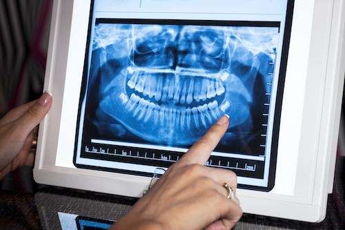 Panoramic X-Rays in Wilmette, IL